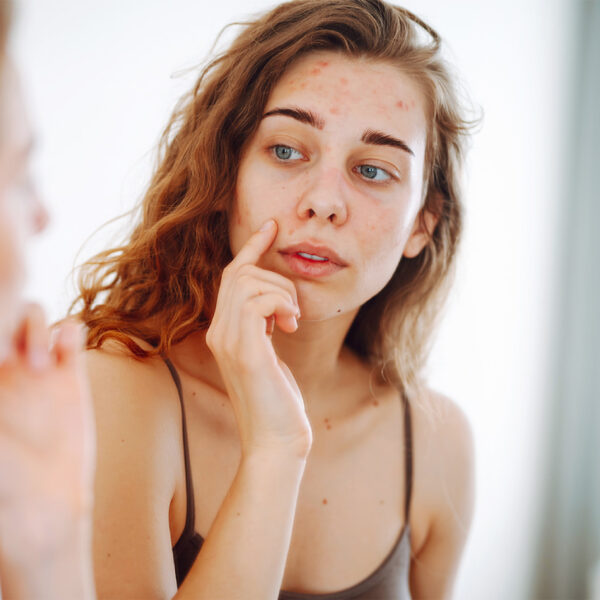 Mlada žena sa sindromom policističnih jajnika gleda svoje lice sklono aknama u ogledalu – Catafertyl