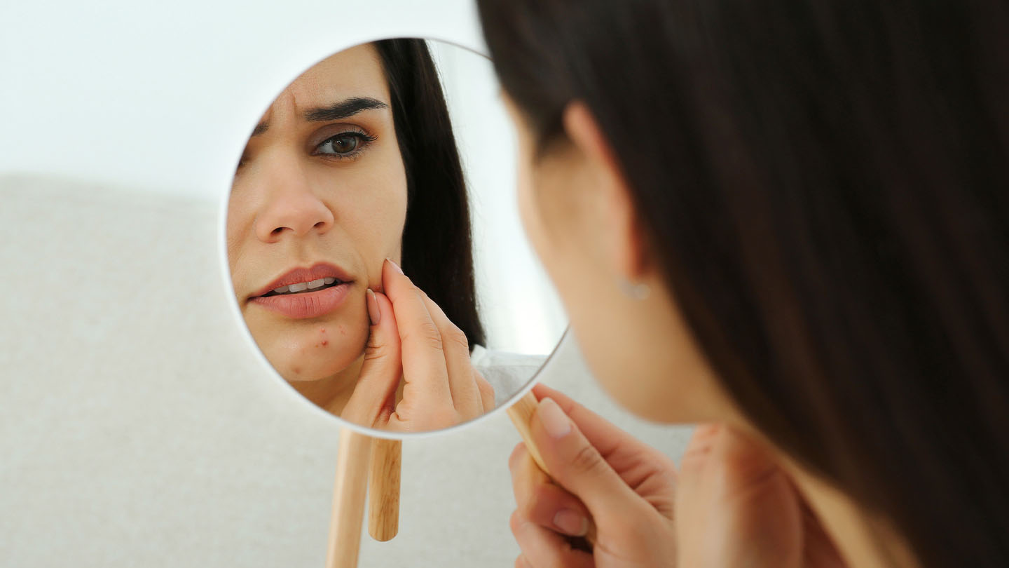 akne-u-ogledalu